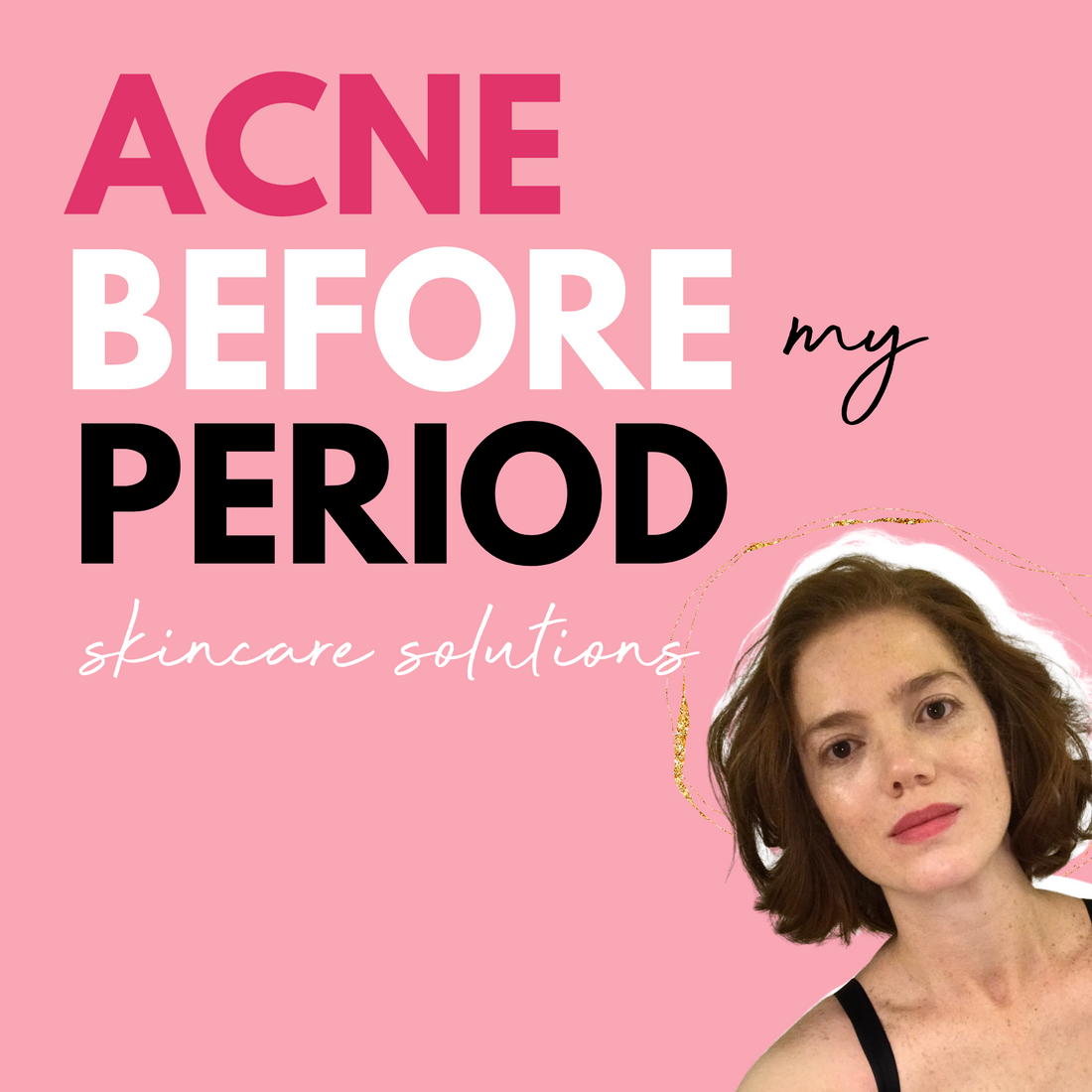 Acne before periods | hormonal acne