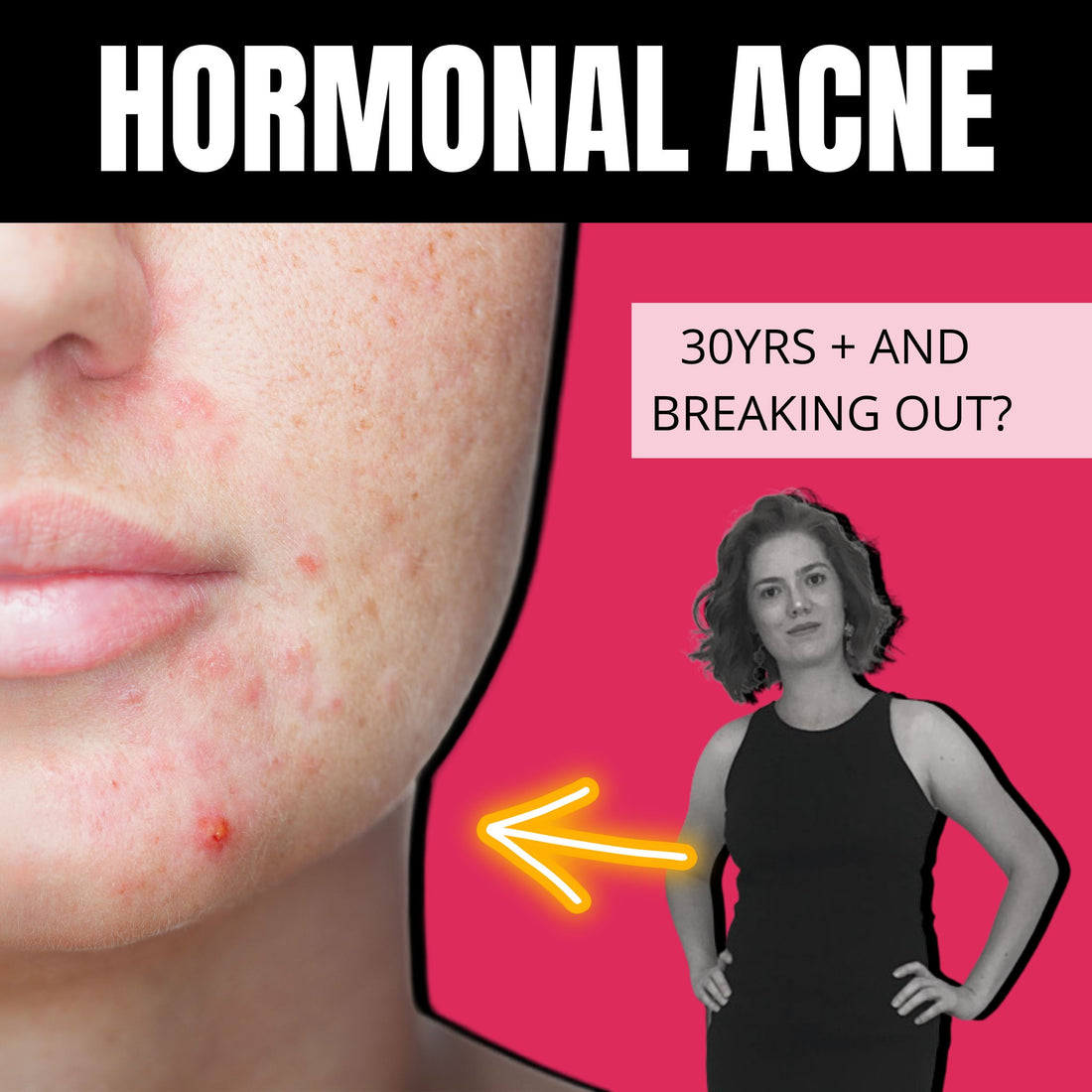 Hormonal acne skincare solutions for clear skin
