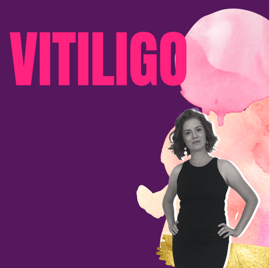 Vitiligo new treatments with great results